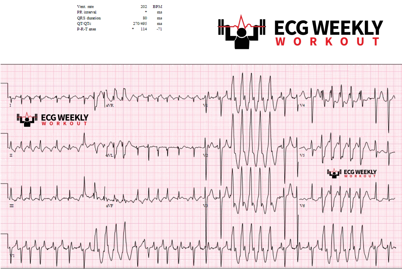 Presenting ECG — STAT ECG Diagnoses: intermittent runs of nonsustained ventricular tachycardia vs. aberrant conduction