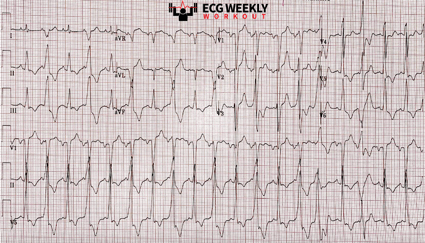 Presenting ECG — ECG Basics and Fundamentals: the value of ignoring the ECG computer interpretation and looking closely at all 12 leads