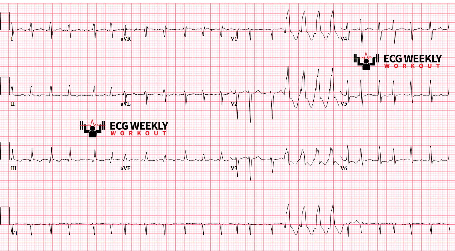 Presenting ECG — STAT ECG Diagnoses: what exactly is Ashman phenomenon and why does it matter?