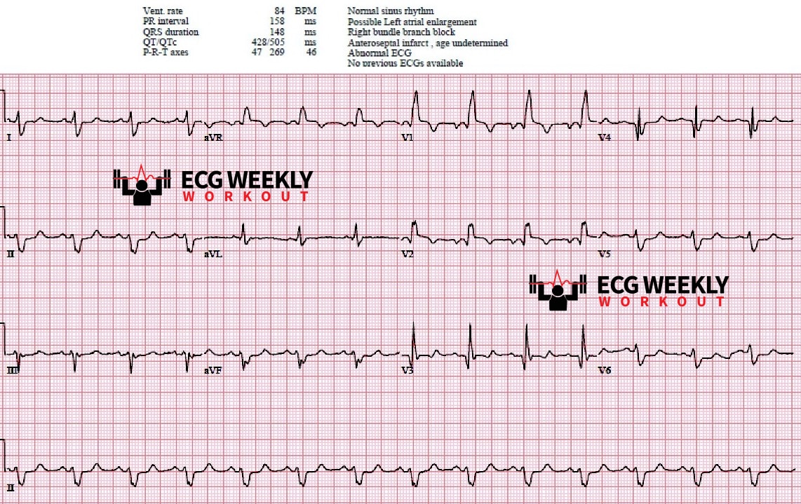 Presenting ECG — STAT ECG Diagnoses: any ST segment elevation in patients with right bundle branch blocks (RBBB) is abnormal!