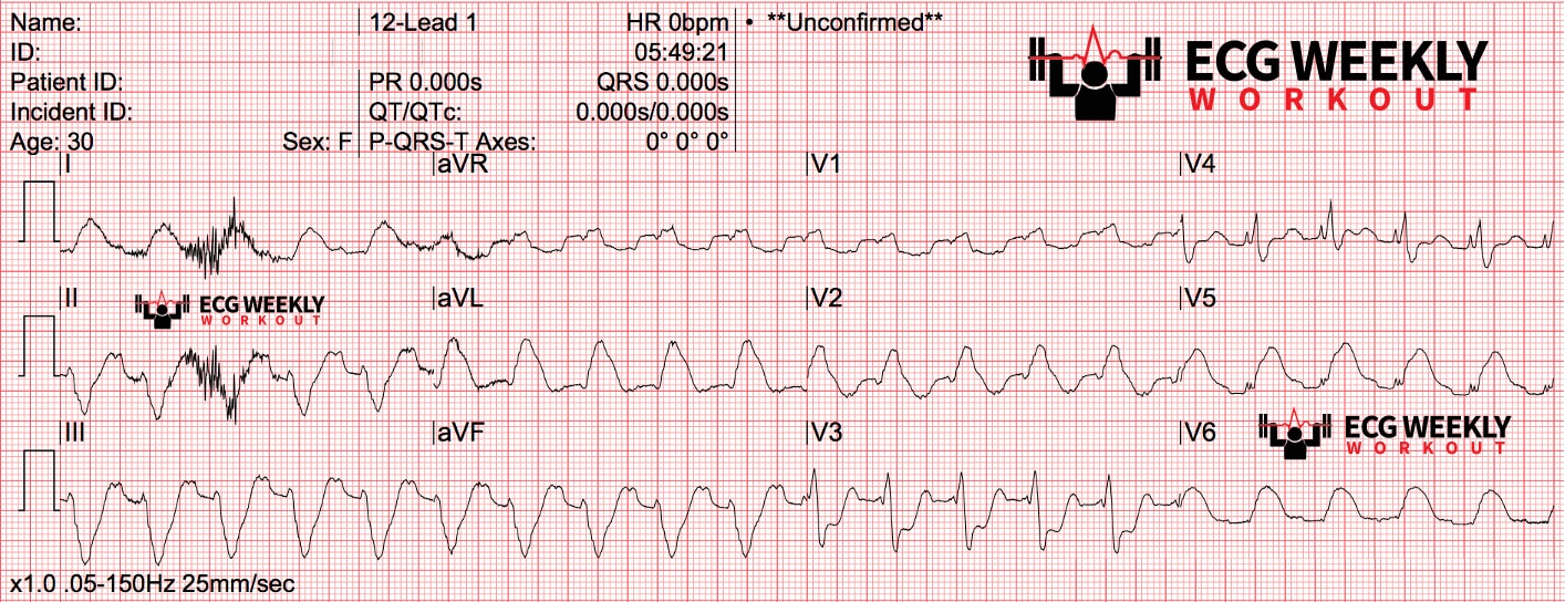 Presenting ECG — STAT ECG Diagnoses: ventricular tachycardia mimics in patients with ST segment elevation