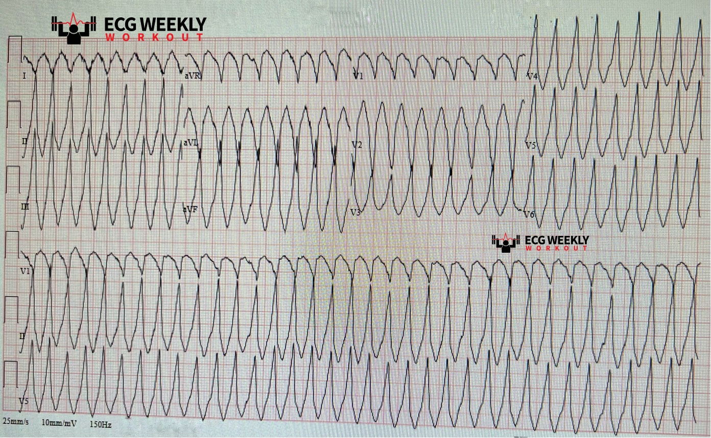 Presenting ECG — STAT ECG Diagnoses: using the ECG in cases of wide complex tachycardia to diagnose ventricular tachycardia (VT)