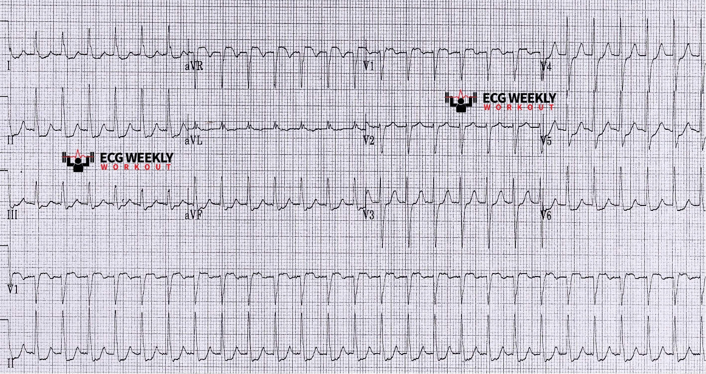 Presenting ECG — Literature Review: troponin testing in patients with supraventricular tachycardias (SVT)