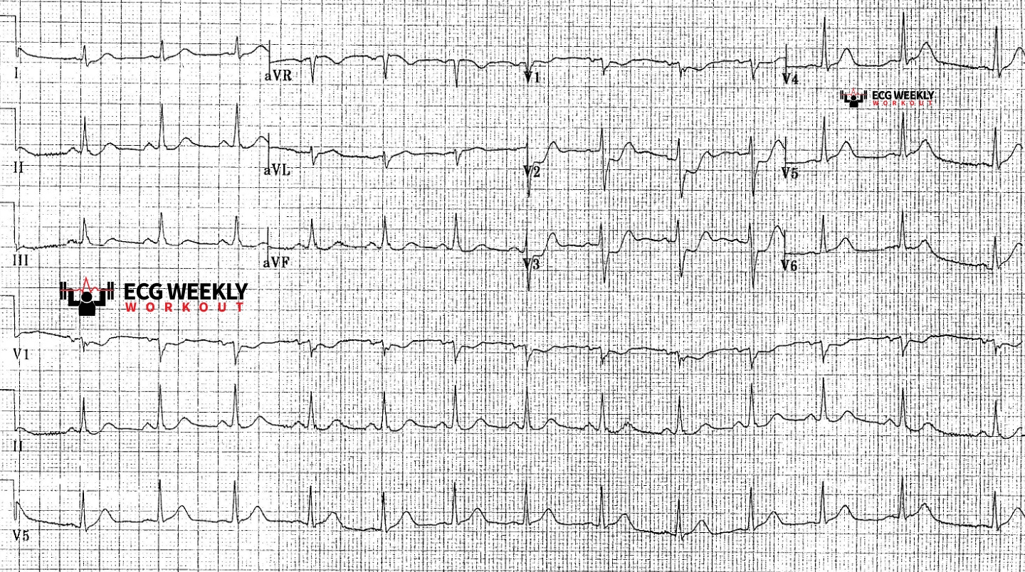 Presenting ECG — STAT ECG Diagnoses: can you have a STEMI without any ST segment elevation on the 12 lead ECG?
