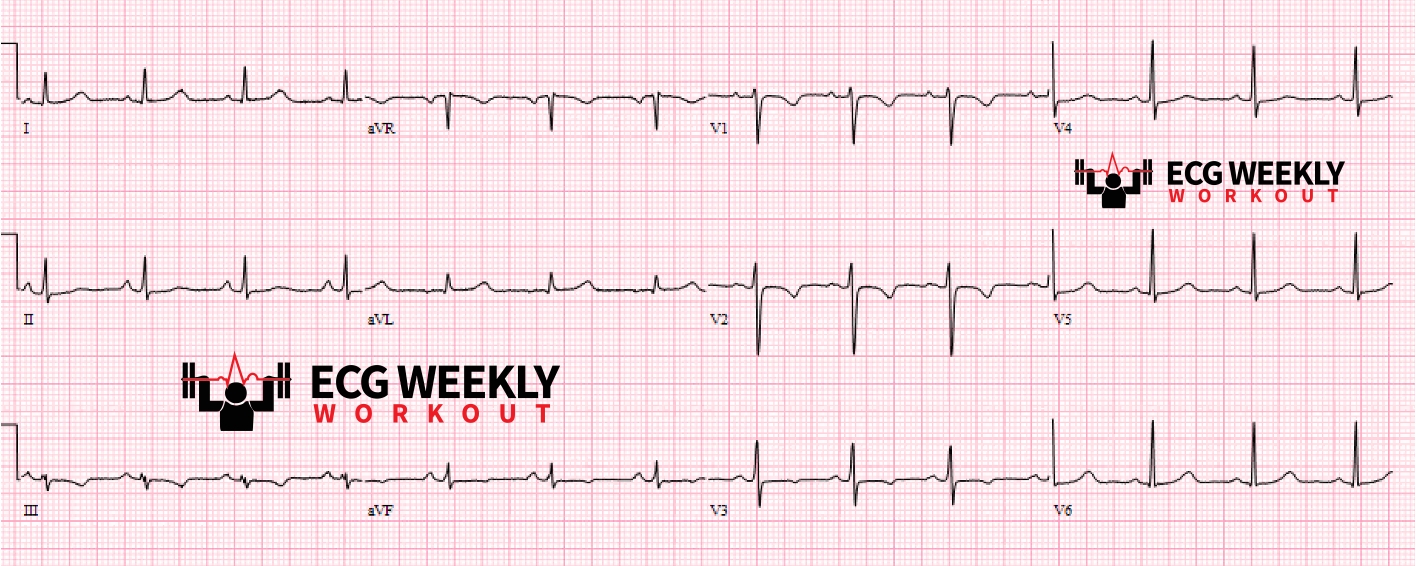 Presenting ECG — Differential Diagnoses: T wave inversions in a young woman with chest discomfort