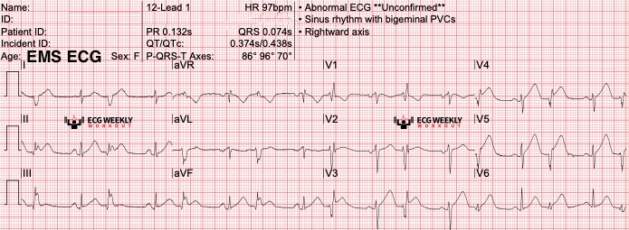 Presenting ECG — STAT ECG Diagnoses: what to do when the ST segment elevation in presumed STEMI resolves before patients get to the cath lab?