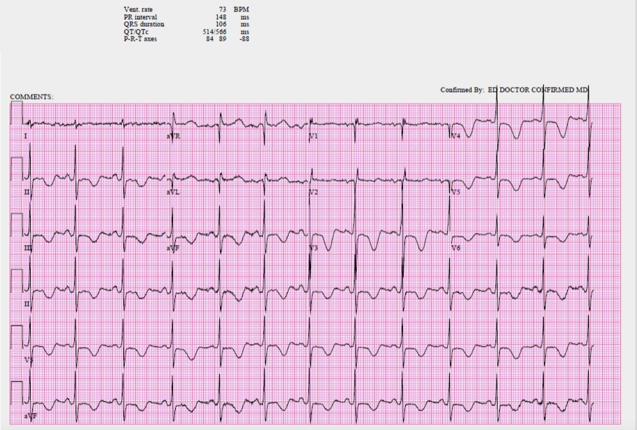 Presenting ECG — Differential Diagnoses: findings of occlusion MI in patients with right bundle branch block (RBBB), prolonged QT intervals, and so much more!