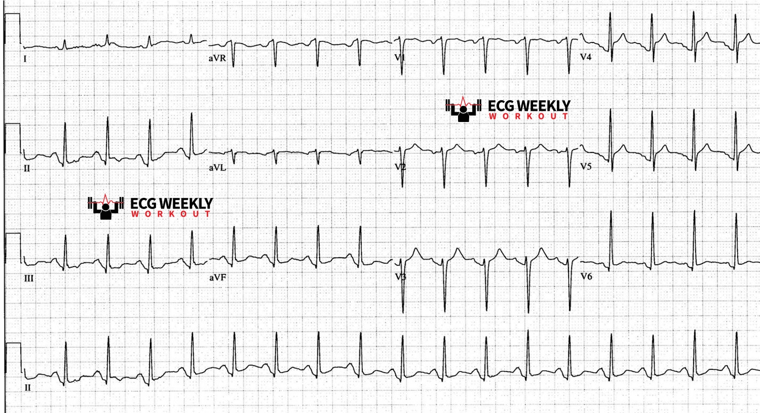 Presenting ECG — ECG Basics and Fundamentals: PR segment or TP? the isoelectric baseline you should use to measure ST segment deviation
