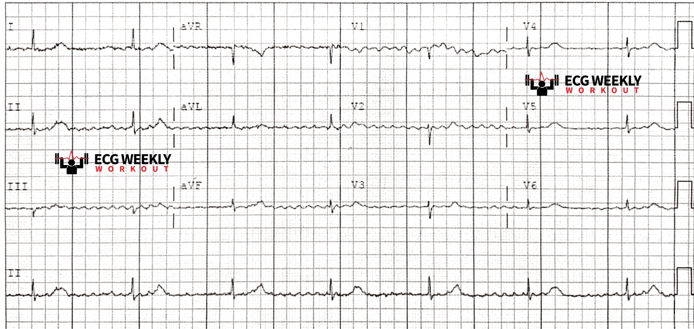 Presenting ECG — Potpourri of cases: using Sgarbossa criteria to diagnose acute occlusion myocardial infarction in LBBB and RV pacers, bizzare bradycardias, and so much more!