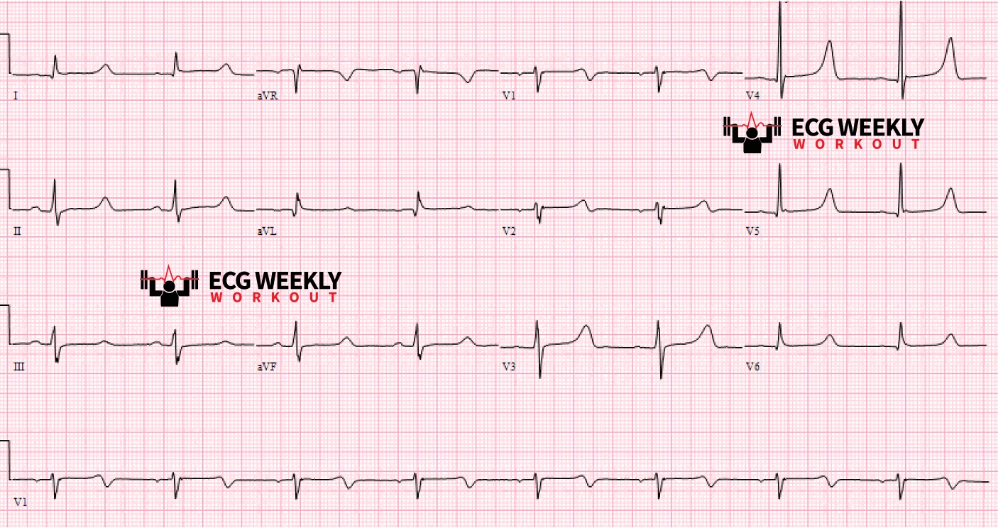 Presenting ECG — Differential DIagnoses: AV blocks, prolonged QTc intervals, T wave inversions, and more!