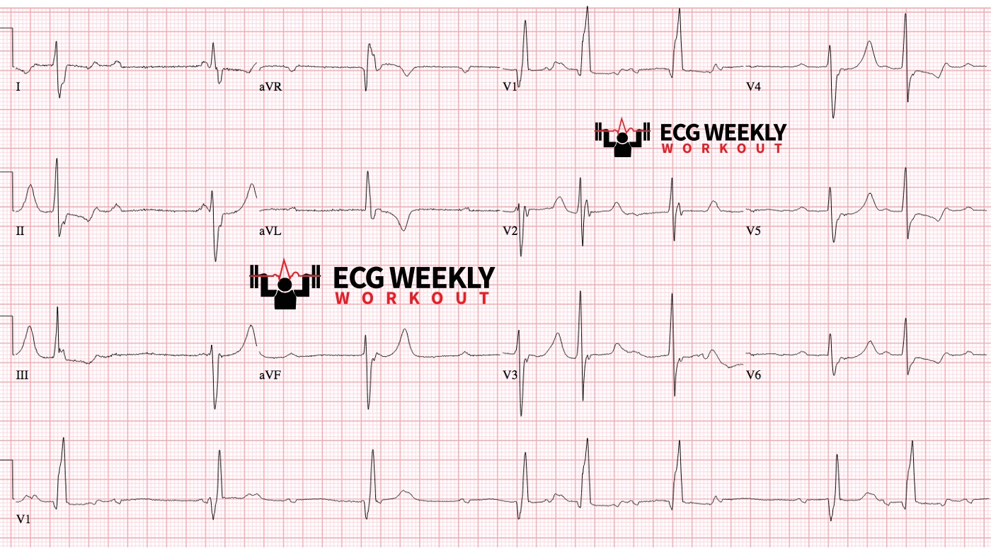Presenting ECG — Rhythm Interpretation: electrocardiographic polyuria (too much P...waves) and how to successfully break down complicated rhythms