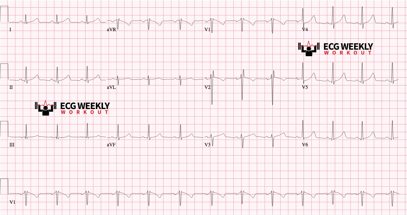 Presenting ECG — ECG Basics and Fundamentals: T wave inversions and the importance of precordial lead placement