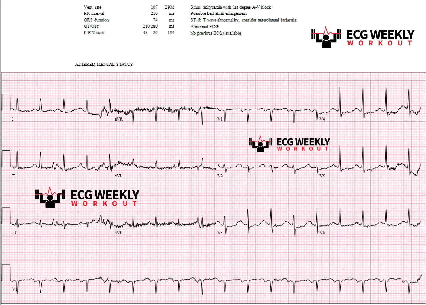 Presenting ECG — Wide Complex Tachycardias: what you gotta know about the two major types of polymorphic ventricular tachycardia