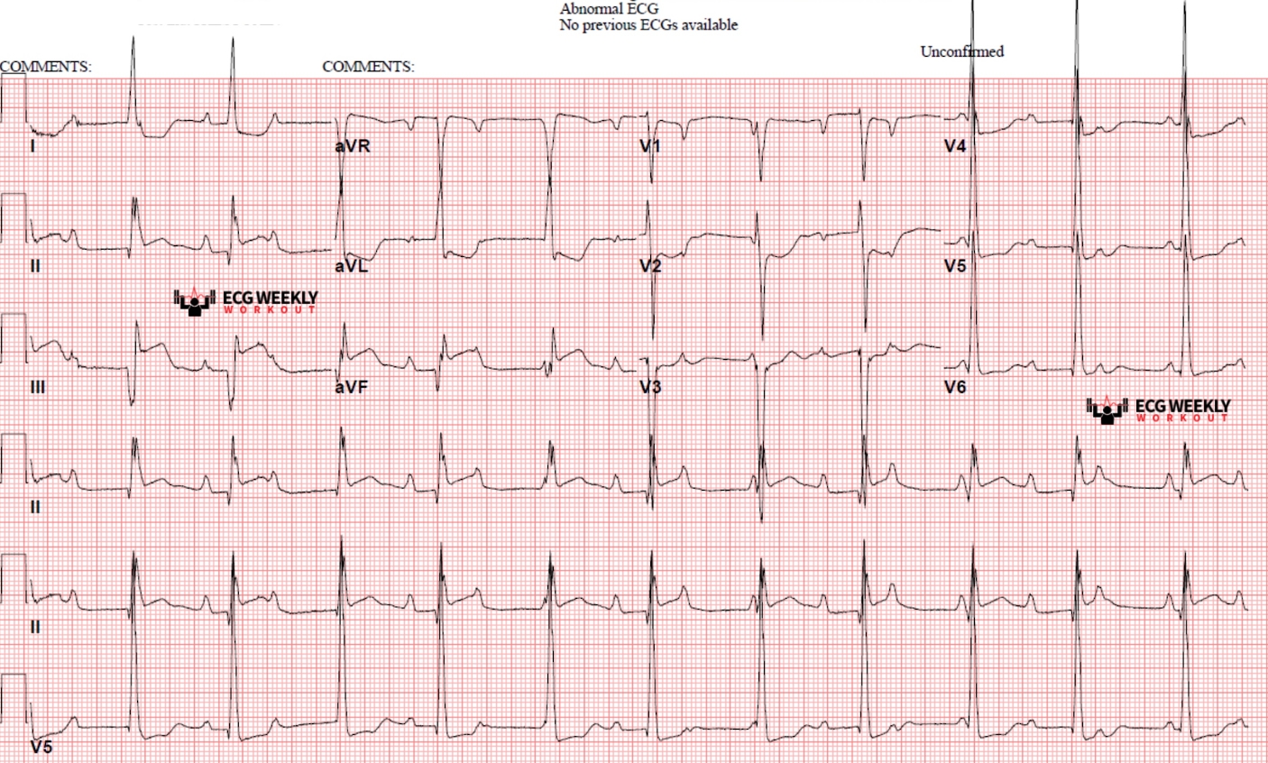 Presenting ECG — Bradyarrhythmias: the types of acute myocardial infarction associated with heart block