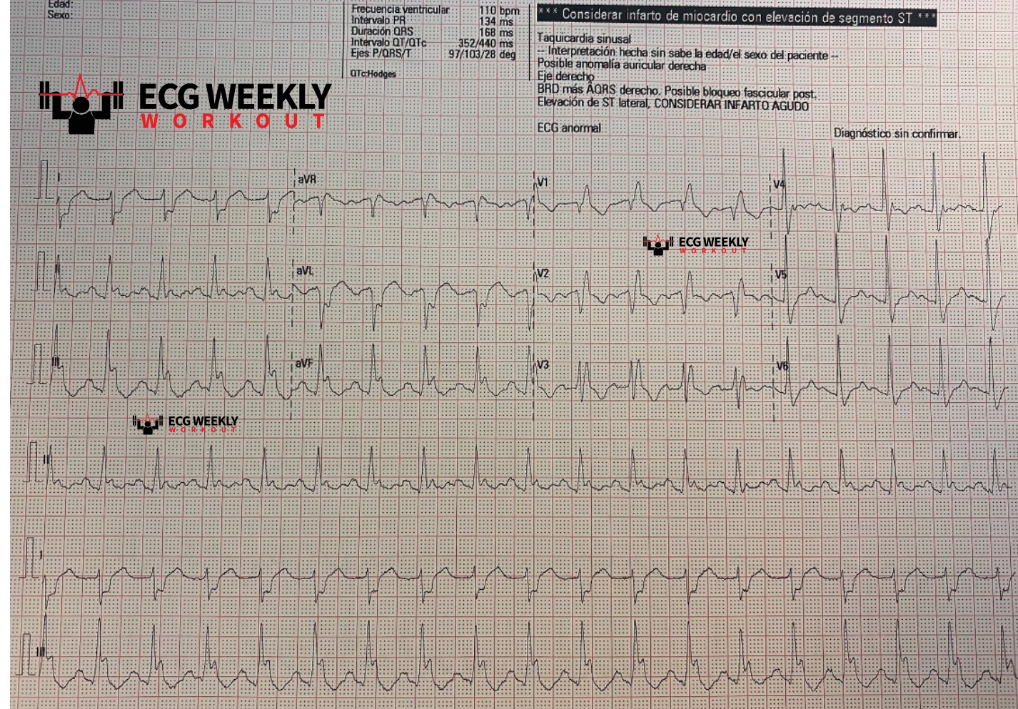 Presenting ECG — STAT ECG Diagnoses: causes of right axis deviation, and evaluation of ST segments in patient with right bundle branch block (RBBB)