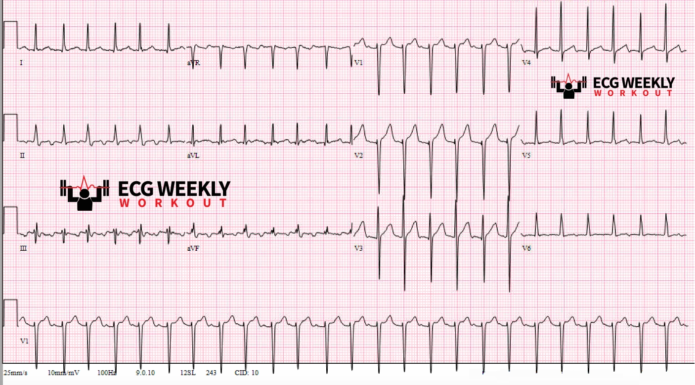 Presenting ECG — Narrow Complex Tachycardia: sinus tachycardia, atrial flutter, or SVT?