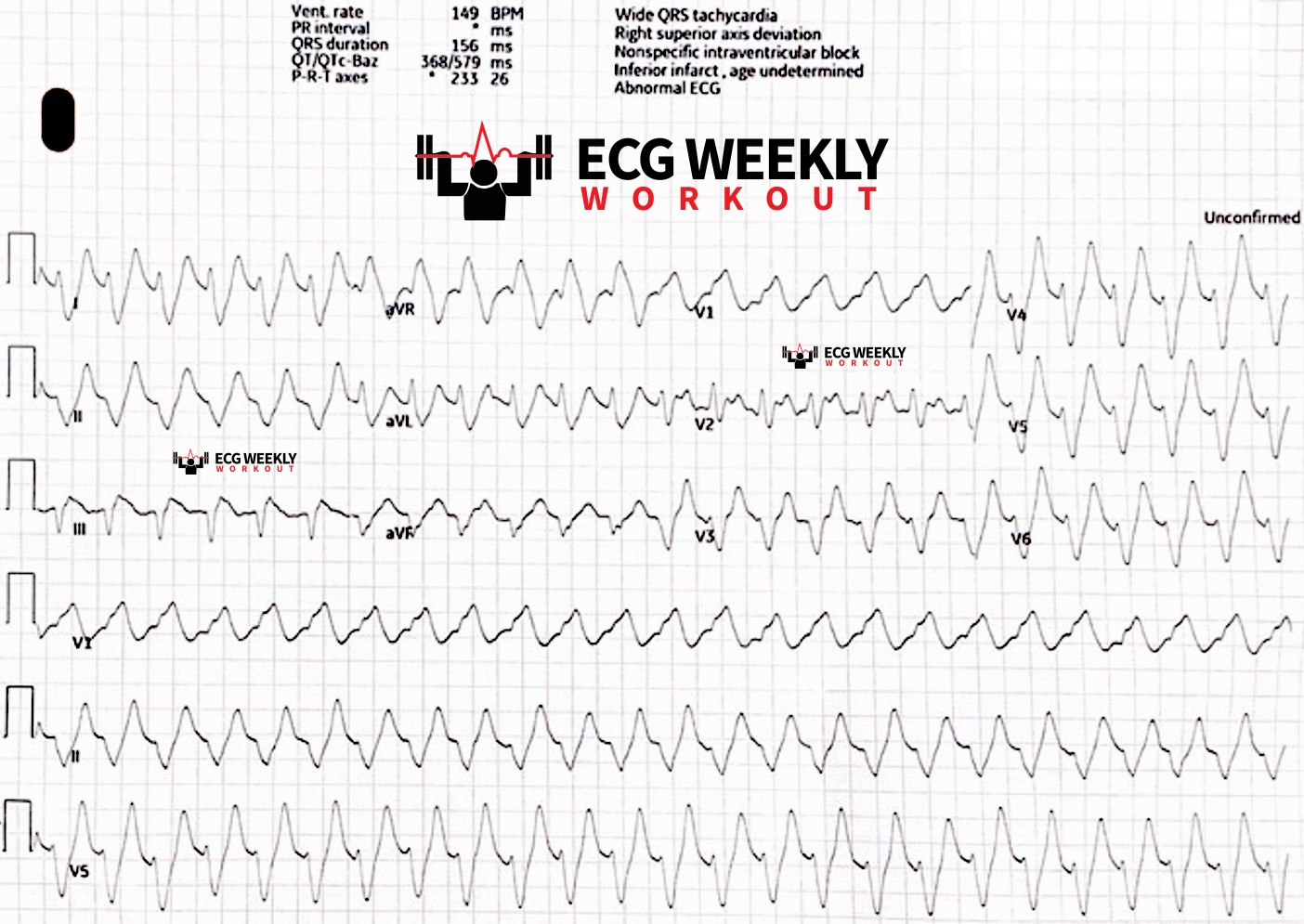 Presenting ECG — Differential Diagnoses: what you gotta know about regular wide complex tachycardias