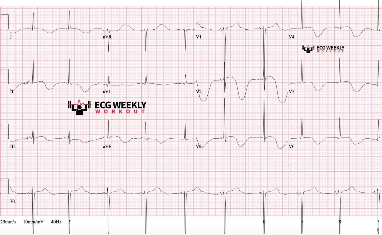 Presenting ECG — Potpourri of cases: differential diagnoses for long QTc intervals, diagnosing occlusion MI in LBBB and paced rhythms, and so much more!