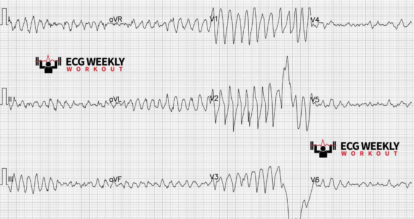 Presenting ECG — Potpourri of cases: generic polymorphic ventricular tachycardia vs. torsades de pointes, regularized atrial fibrillation, and much more!