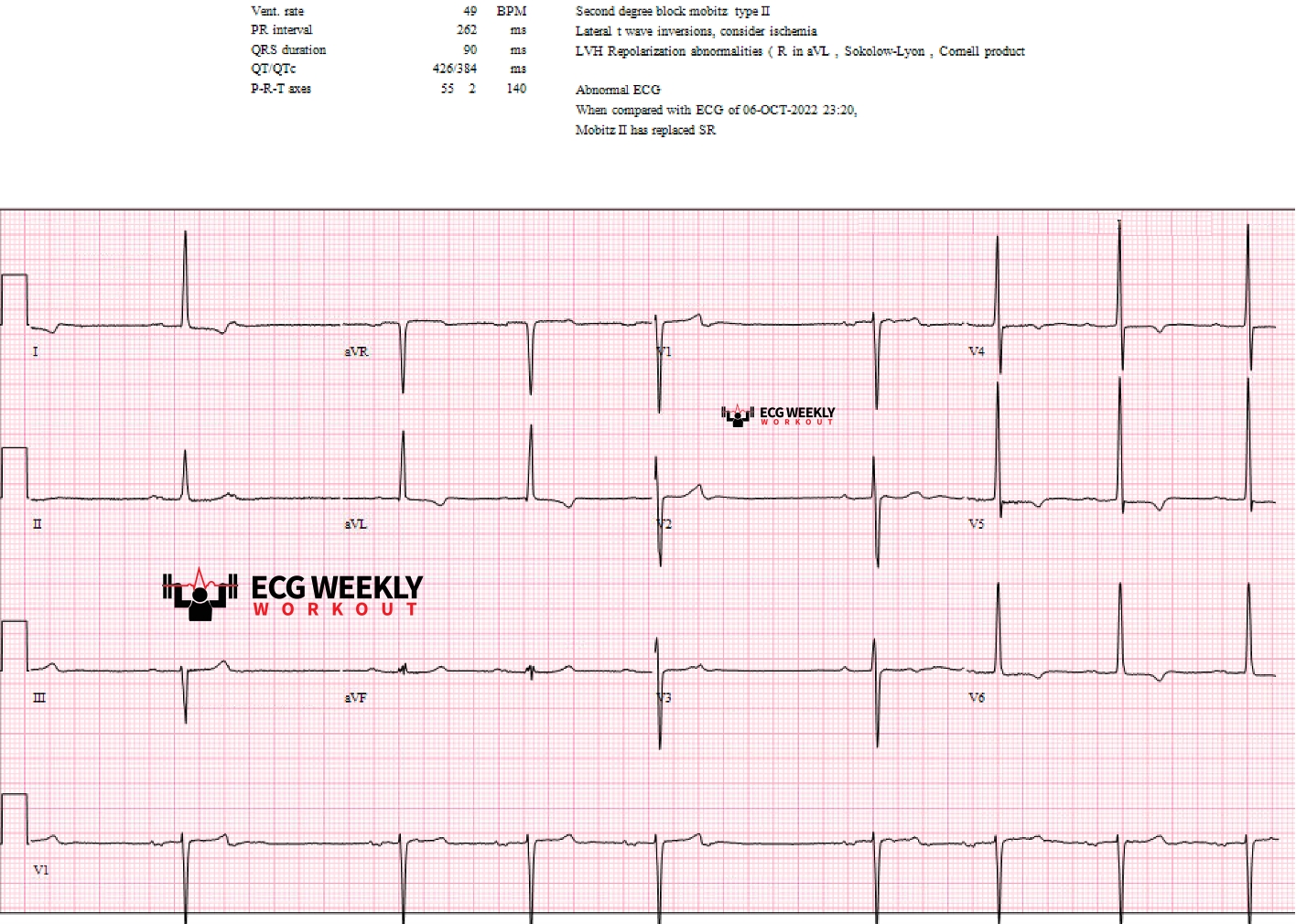Presenting ECG — ECG Basics and Fundamentals: causes of pauses or clumped/grouped beats on the ECG