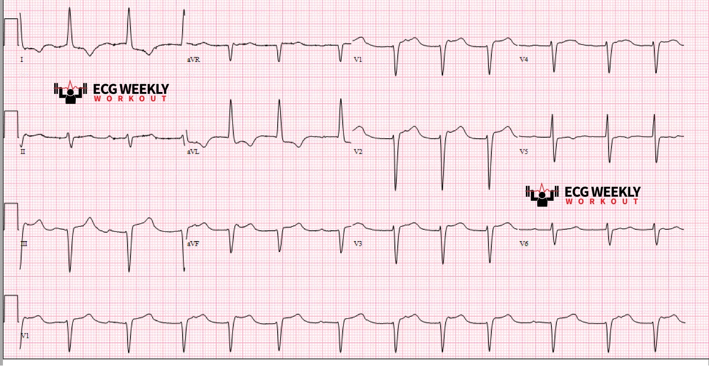 Presenting ECG — STAT ECG Diagnoses: how to approach and tackle tough dysrhythmias
