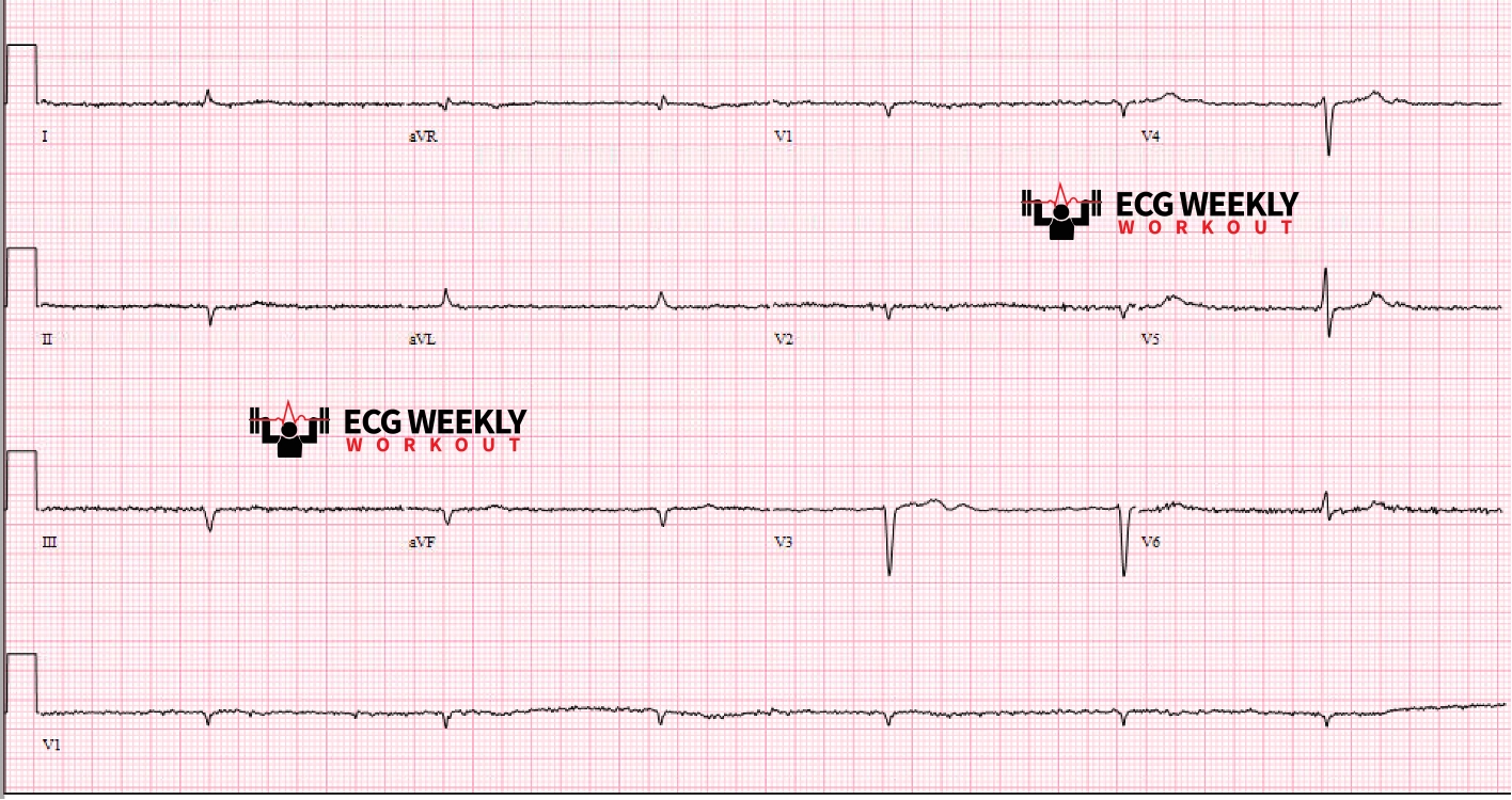 Presenting ECG — STAT ECG Diagnoses: differential diagnoses for low voltage QRS complexes and ventricular arrhythmias in patients with left ventricular assist devices (LVADs)