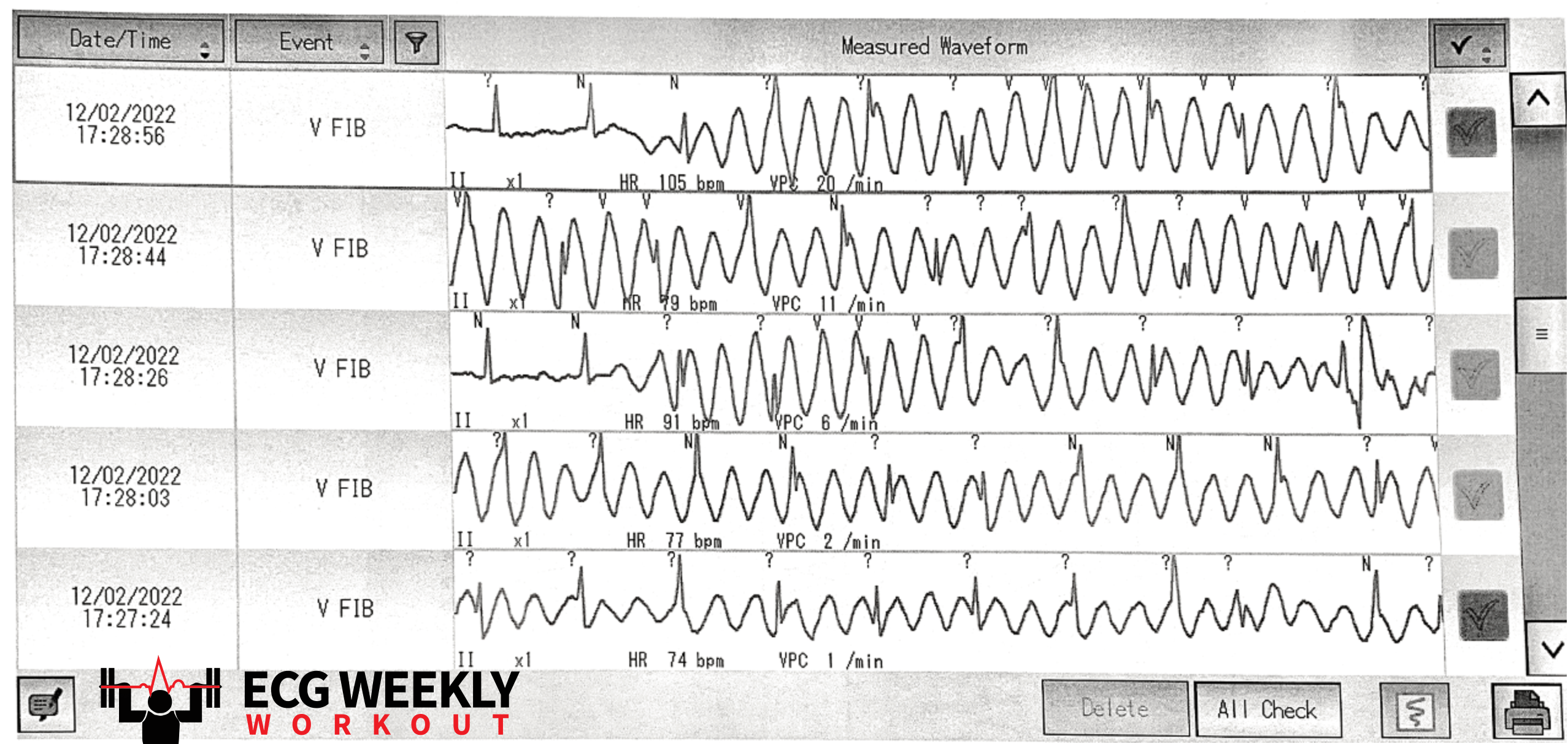 Presenting ECG — Rhythm interpretation: when to worry about cardiac rhythm strips