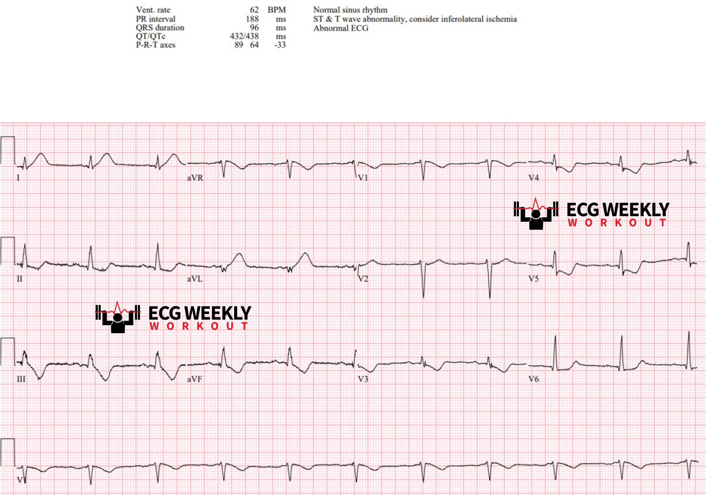 Presenting ECG — STAT ECG Diagnoses: early ECG signs of cardiac ischemia and acute coronary occlusion