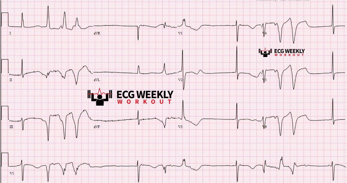 Presenting ECG — Several ECG cases from UMEM that highlight the importance of pattern recognition and a good history to differentiate between benign vs. life threatening ECG findings!