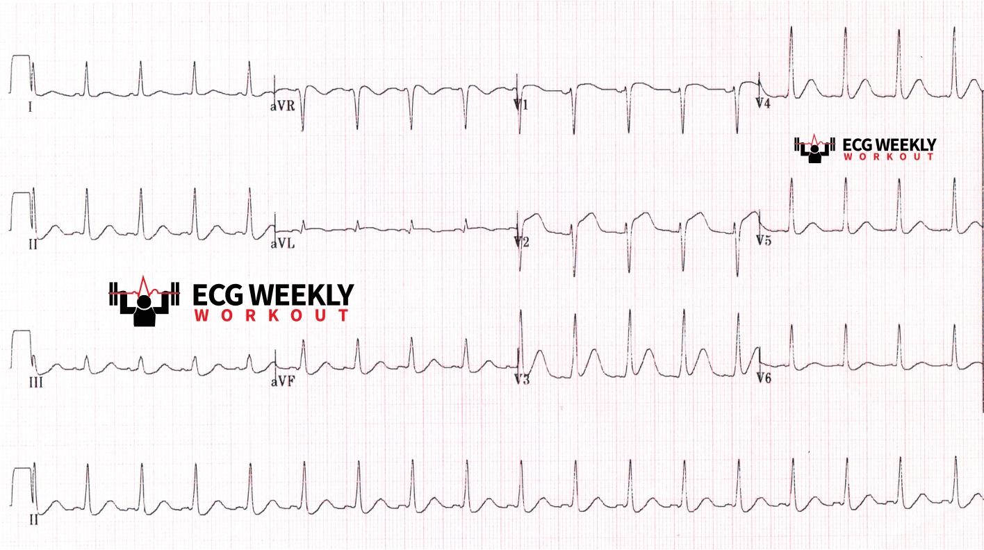 Presenting ECG — STAT ECG Diagnoses: a safe approach to the evaluation of patients with diffuse ST segment elevation