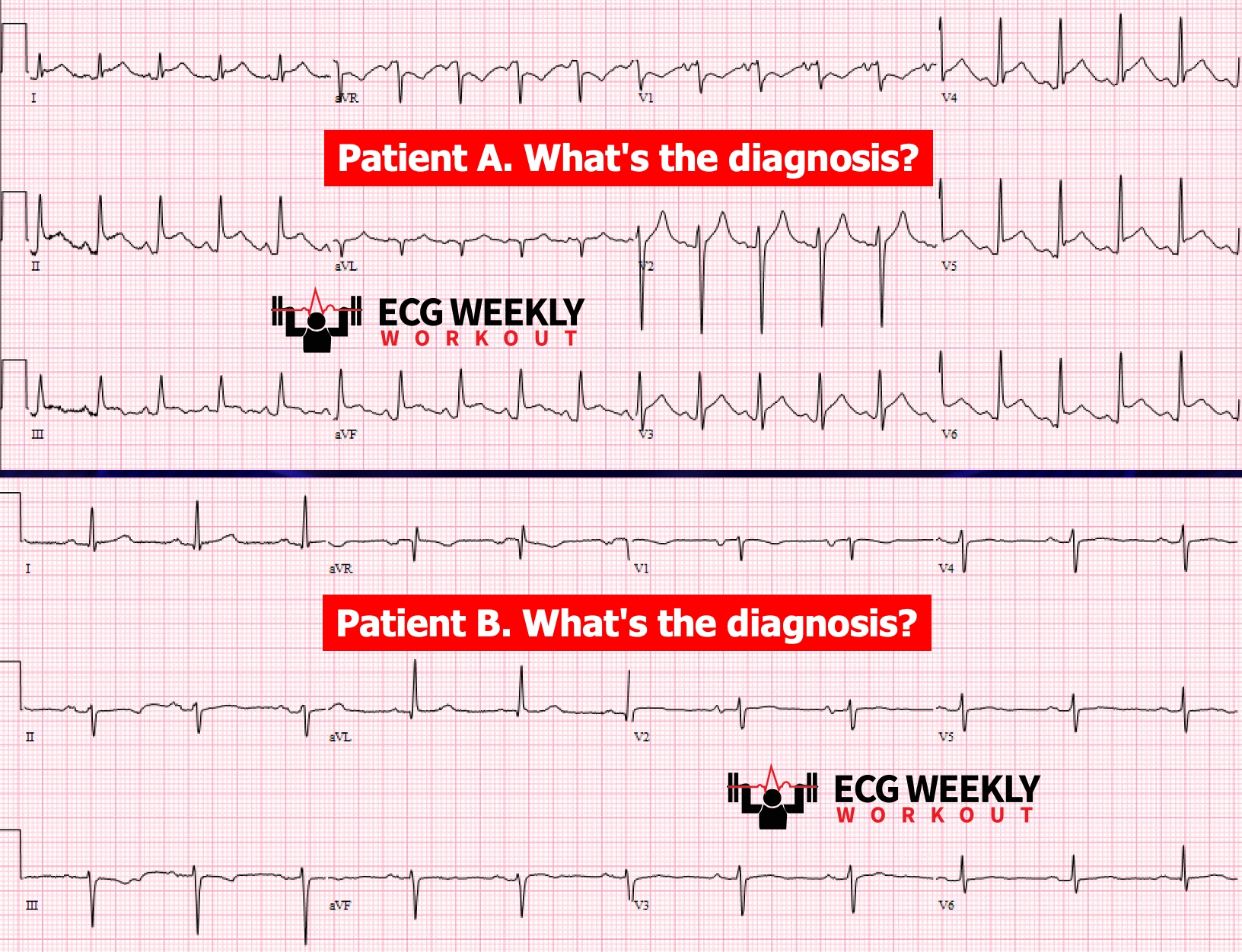Presenting ECG — STAT ECG Diagnoses: are ECG abnormalities necessary for the diagnosis of acute pericarditis?