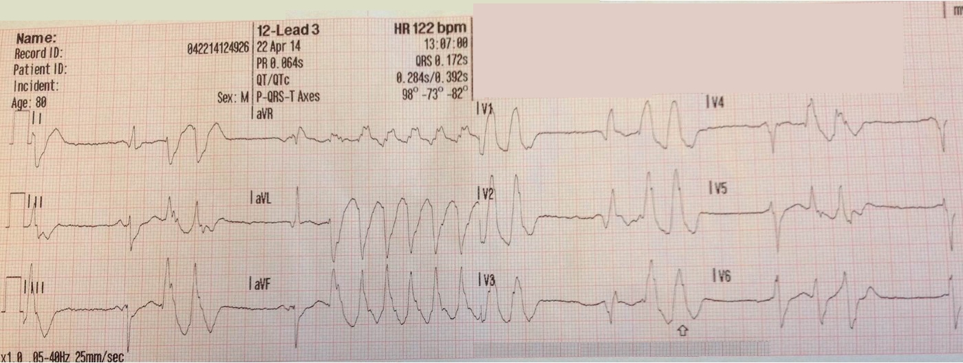 Presenting ECG — Hyperacute T waves and serial ECGs in early ACS, AV blocks, and more on sustained vs. nonsustained ventricular tachycardia