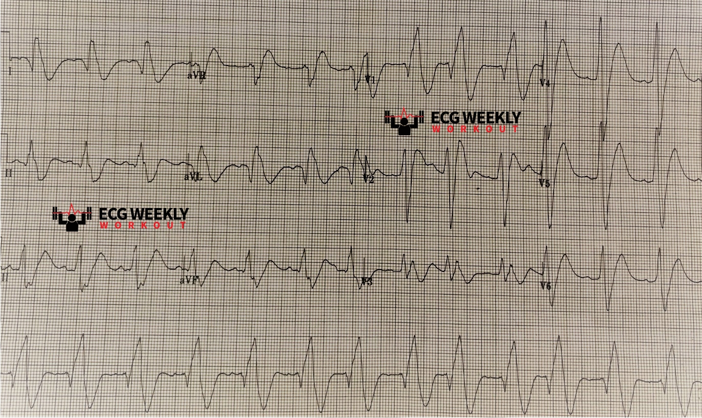 Presenting ECG — Differential Diagnoses: must know causes of right axis deviation and wide QRS complexes
