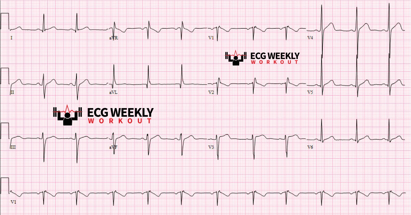 Presenting ECG — ECG Basics and Fundamentals: things that can go wrong in leads V1 & V2