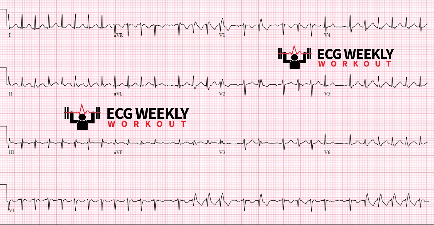 Presenting ECG — Rhythm Interpretation: Ashman phenomenon vs. nonsustained ventricular tachycardia