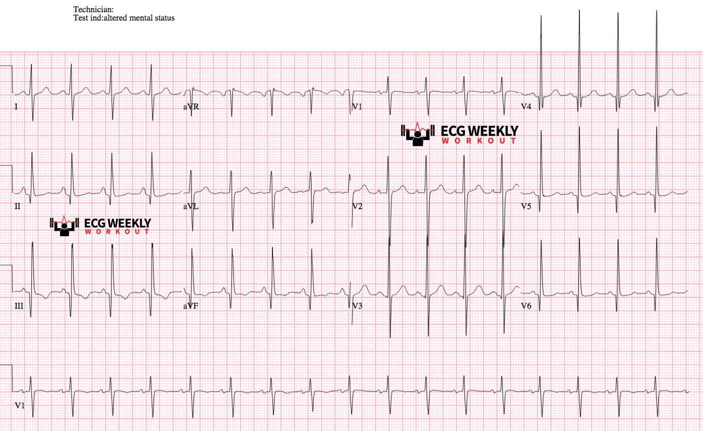 Presenting ECG — Differential Diagnoses: must know cardiac causes of syncope