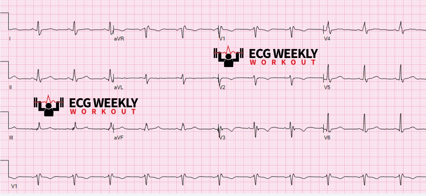 Presenting ECG — Differential Diagnoses: what to consider in patients who have isolated syncope and present asymptomatic