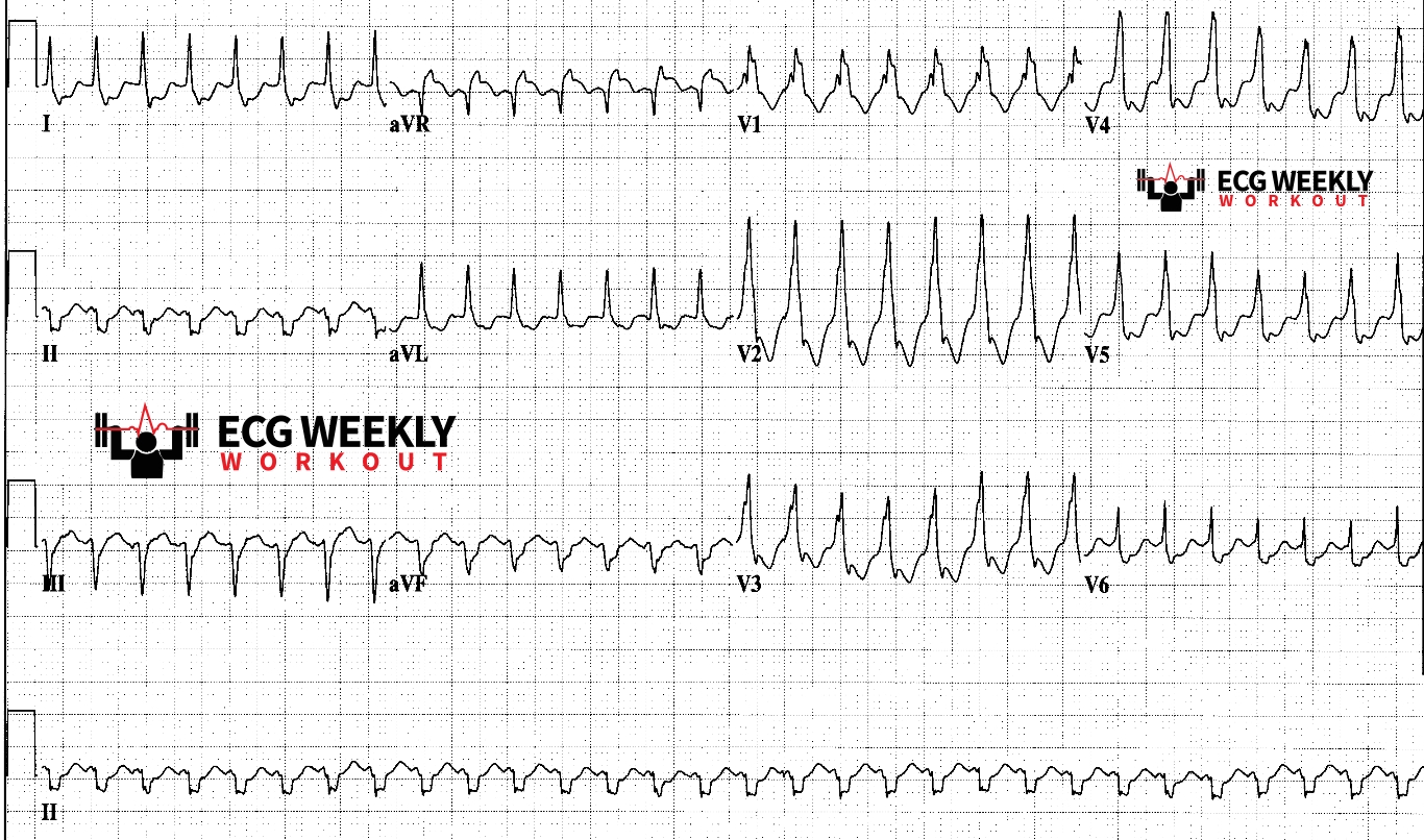 Presenting ECG — Wide Complex Tachycardias: can ECG algorithms safely rule out ventricular tachycardia in the emergency department?