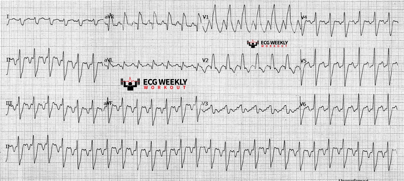 Presenting ECG — Wide Complex Tachycardias: using modified ECG leads to distinguish ventricular tachycardia from supraventricular tachycardias (VT vs. SVT)