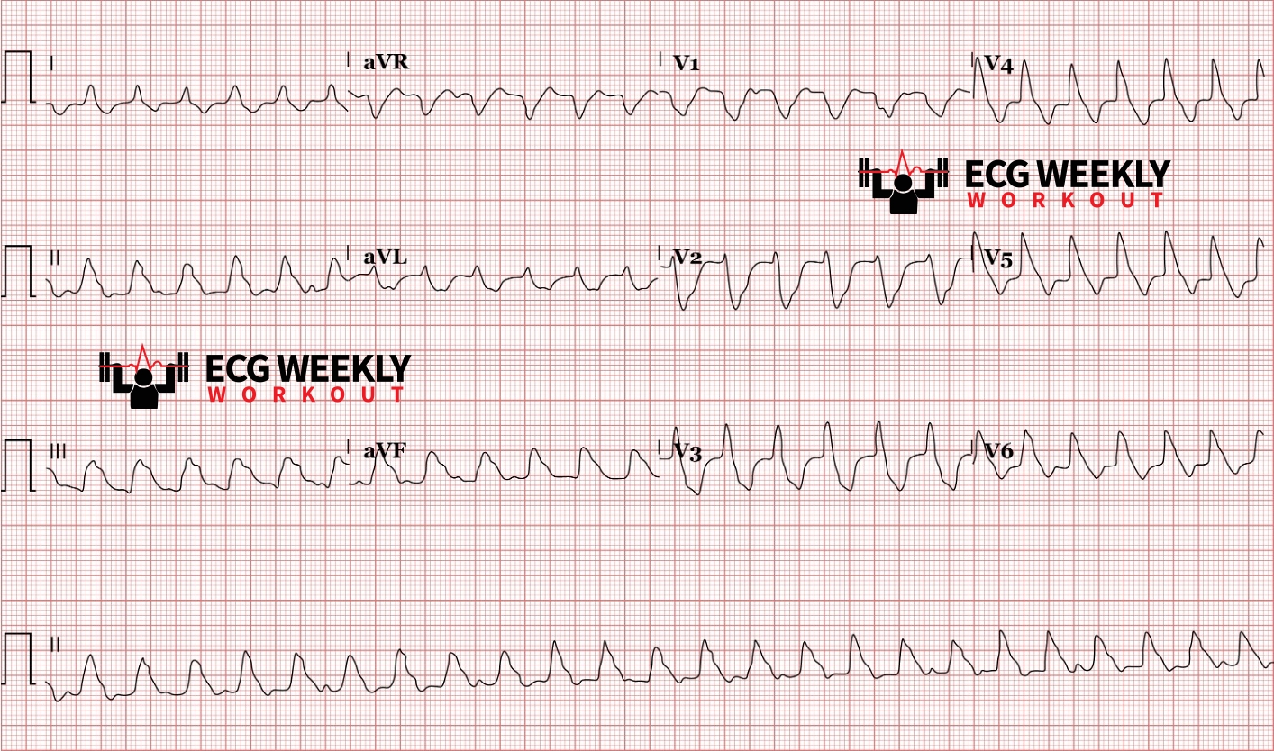 Presenting ECG — Wide Complex Tachycardias: beware the many mimics of ventricular tachycardia