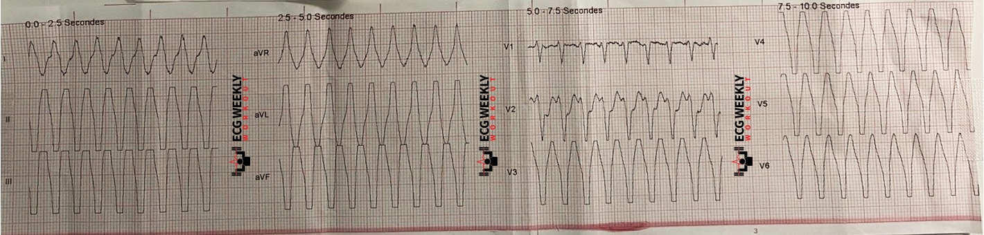 Presenting ECG — Wide Complex Tachycardias: precordial concordance and what to do when some leads appear narrow and others appear wide