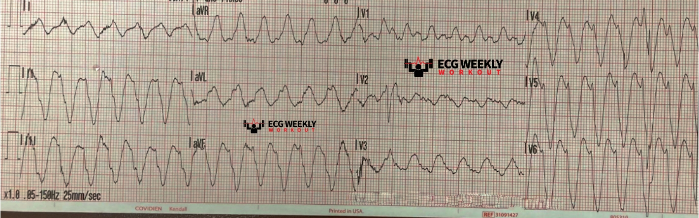Presenting ECG — Wide Complex Tachycardias: clues to VT mimics when the heart rate is too slow or the QRS complexes are too wide