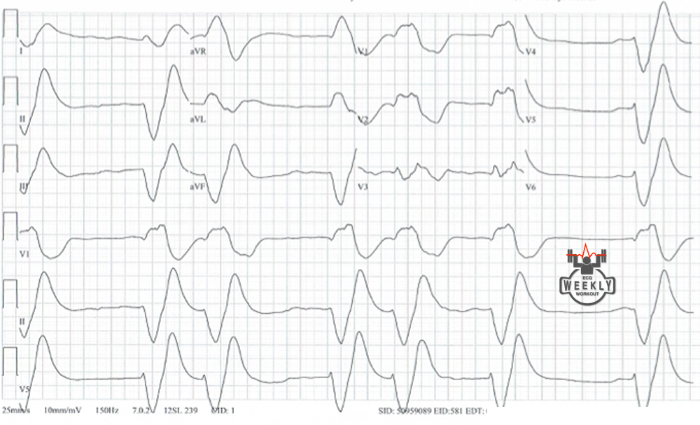 Presenting ECG — Can the ECG be used to diagnose a specific type of paralysis?