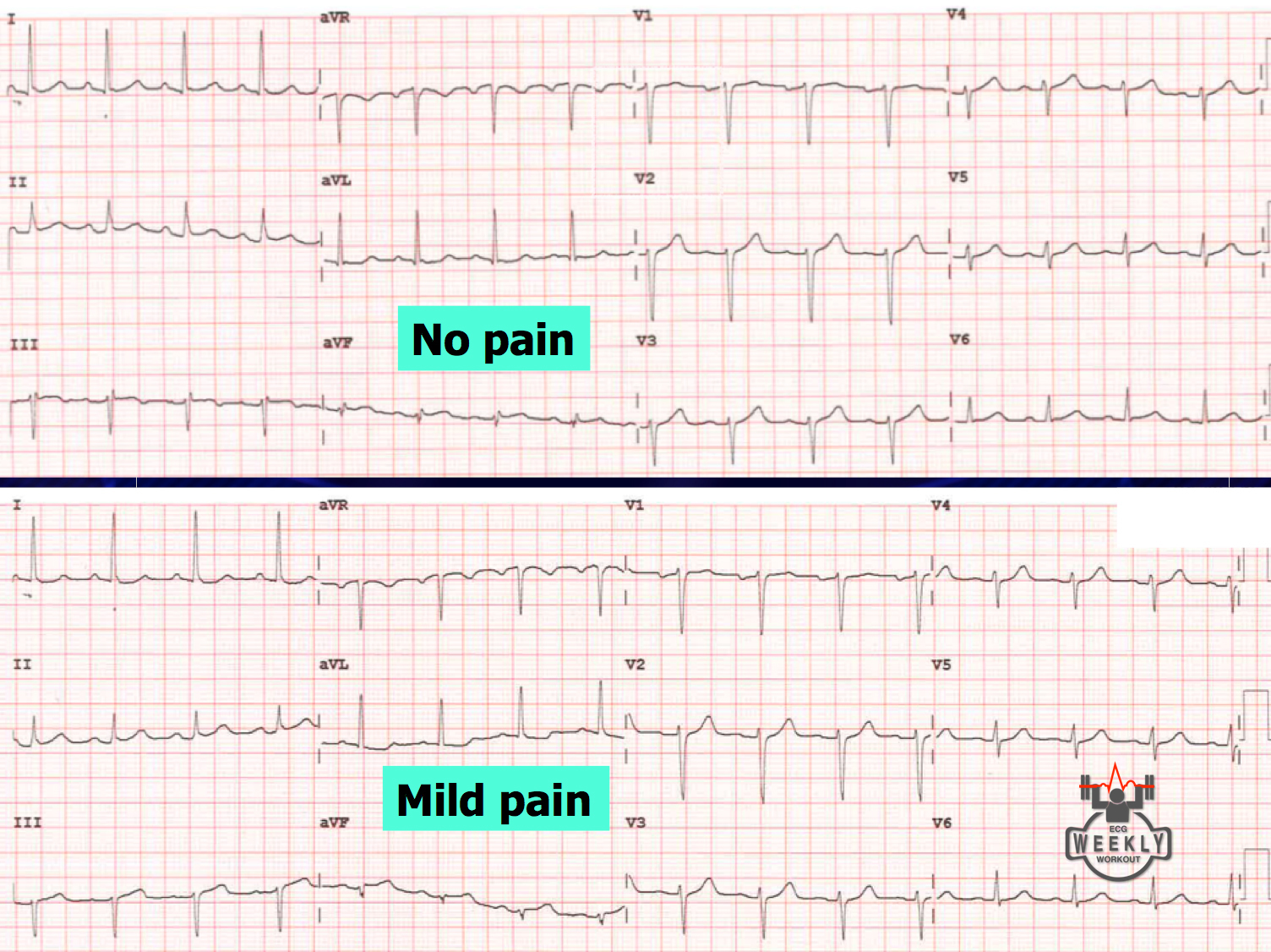 Presenting ECG — ECG Basics & Fundamentals: dynamic ischemic ECG changes in ACS