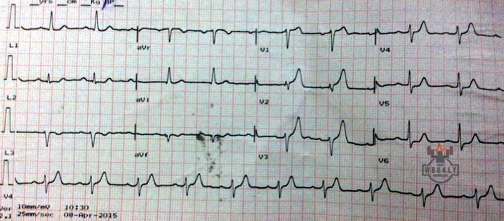 Presenting ECG — Cardiac arrest after this ECG: what is the most likely cause?