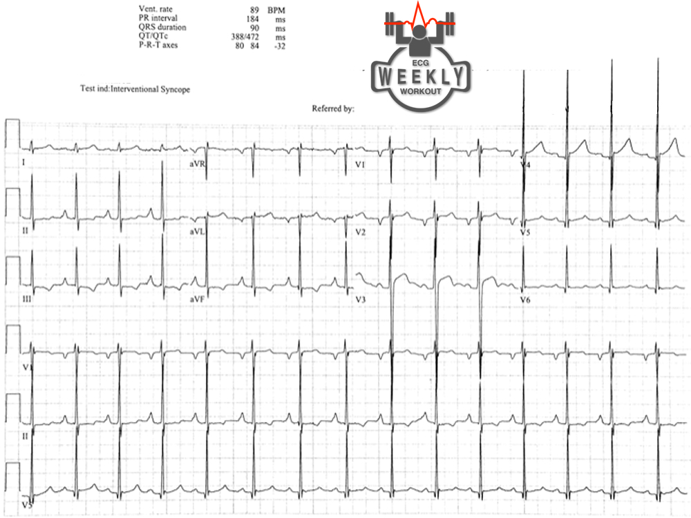 Presenting ECG — Literature Review: syncope evaluation in a young athlete, a review of normal vs abnormal ECG in athletes