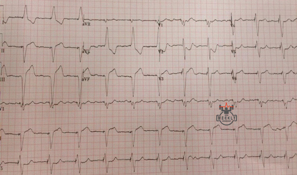 Presenting ECG — Literature in support of Sgarbossa criteria (Part 2/2)