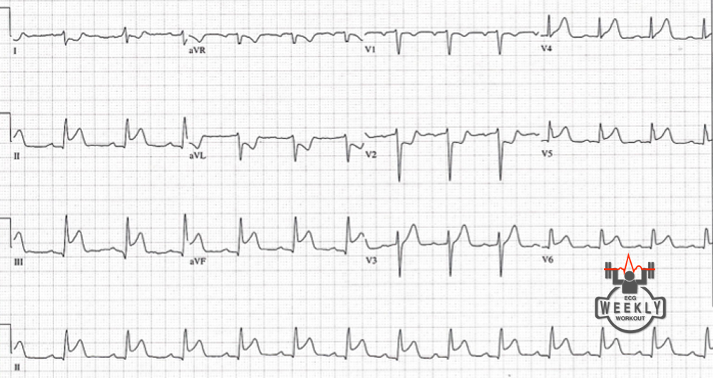 Presenting ECG — STAT ECG Diagnoses: considerations in hypotensive STEMI patients