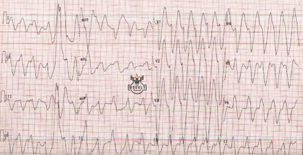Presenting ECG — Differential DIagnoses: right axis deviation, prolonged QT interval, and a wide QRS