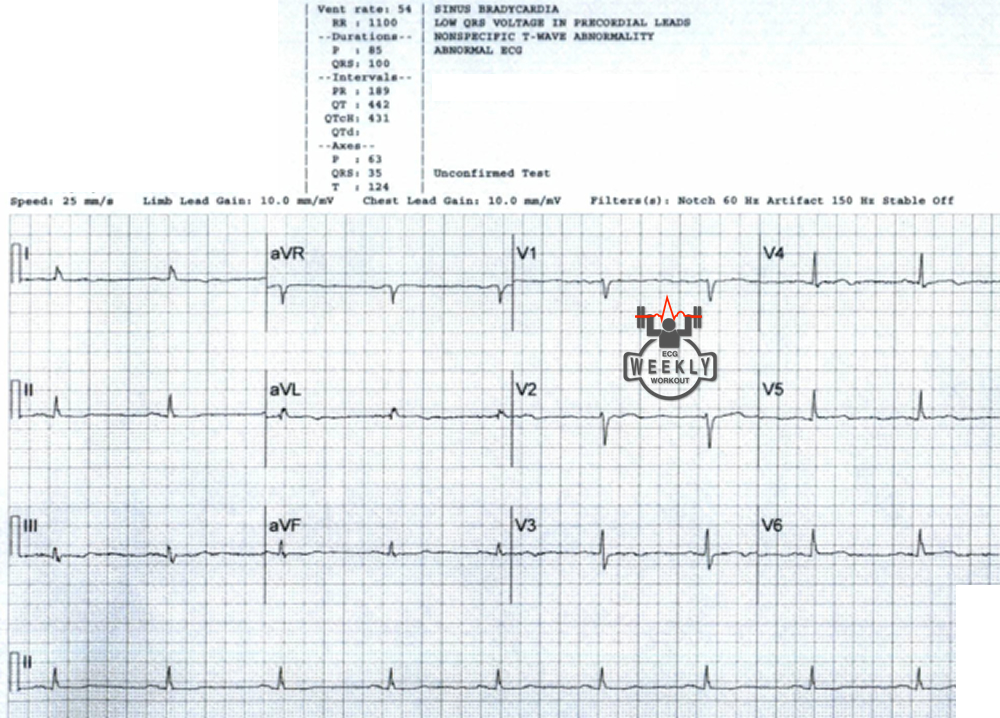 Presenting ECG — Literature Review: non-ST segment elevation ACS